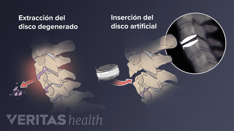 Proceso quirúrgico de una cirugía de reemplazo de disco artificial.