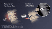 Illustration showing removal of herniated cervical disc and insertion of an artificial disc