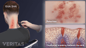 Gua Sha showing petechiae and capillaries breaking beneath the skin