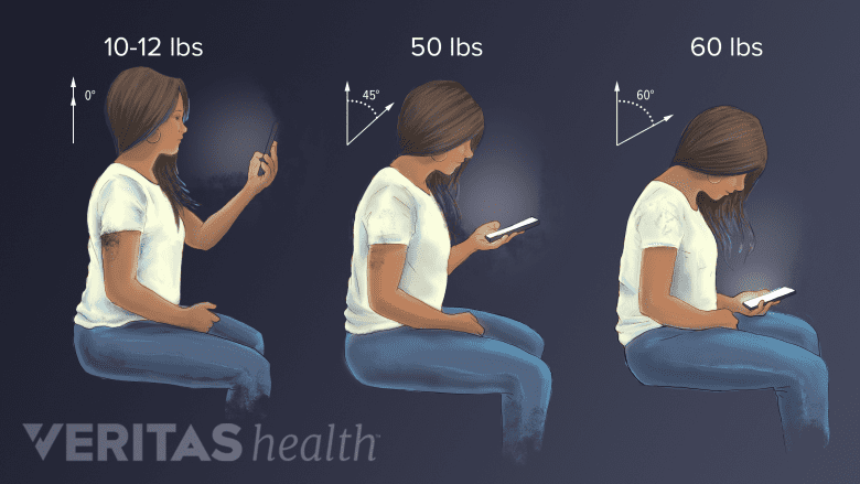 Views of posture in the neck when using a phone showing increase in pressure as you bend your neck.