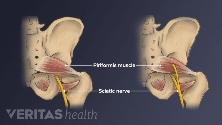 The left side of two pelvises showing the anatomic variation of the sciatic nerve as it courses below the piriformis muscle and through the piriformis muscle.