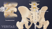 Posterior view of SI joint injections into the joint.