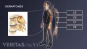 Pain areas of different compressed nerve roots in the cervical spine