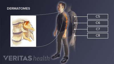 Pain areas of different compressed nerve roots in the cervical spine