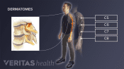 Illustration of areas affected by cervical nerve root causing radiculopathy
