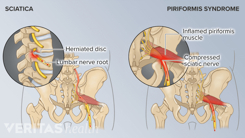 An illustration showing origin of pain in sciatica vs Piriformis Syndrome.