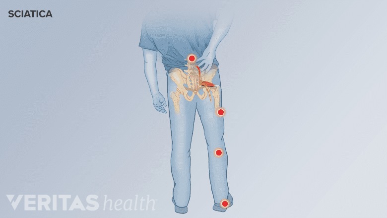 Posterior view of pain in the leg from sciatica.
