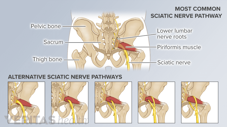 The most common sciatic nerve pathway and 5 other anatomic variations of the nerve&#039;s pathway.