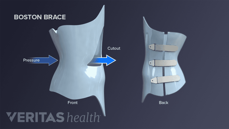 Front view and back view side-by-side of a Boston brace.