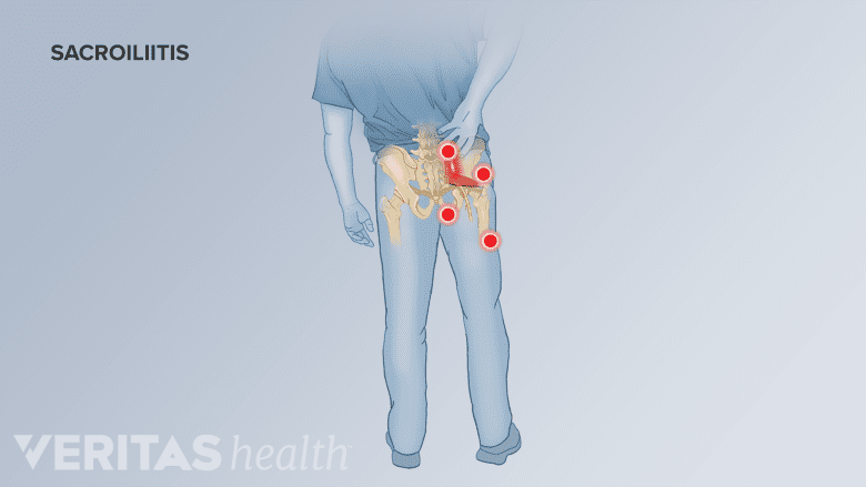 Man from behind holding lower back. Red dots on lower back and hip.