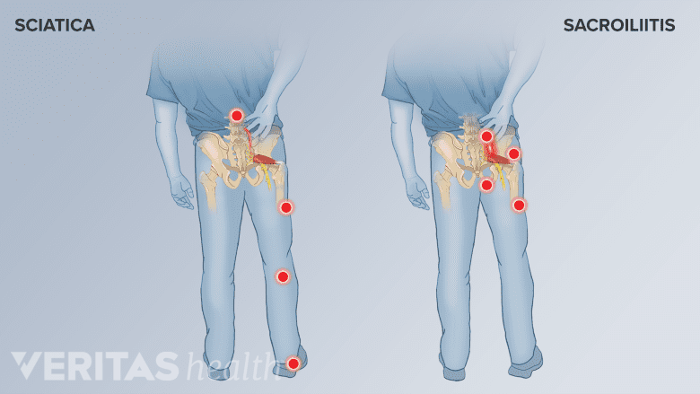 Illustration showing sciatica and sacroillitis pain areas in the low back.