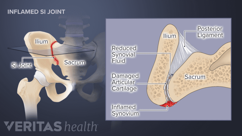 The pelvis, with the SI joint highlighted in red.