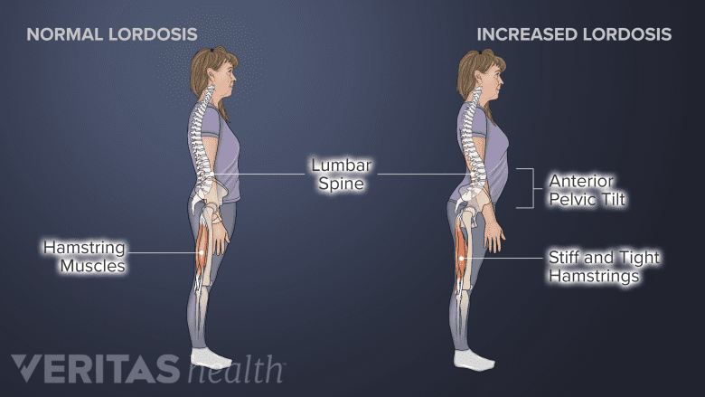 Hamstring tightness and increased lordosis.