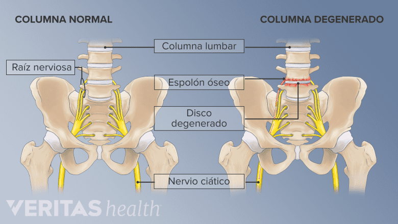Una columna vertebral normal y una degenerativa.