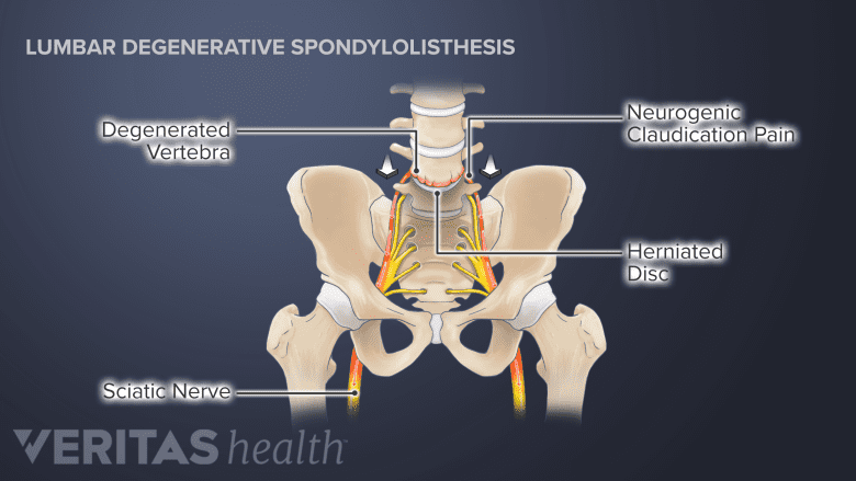 Illustration showing pelvis with degenerative spondylolisthesis.