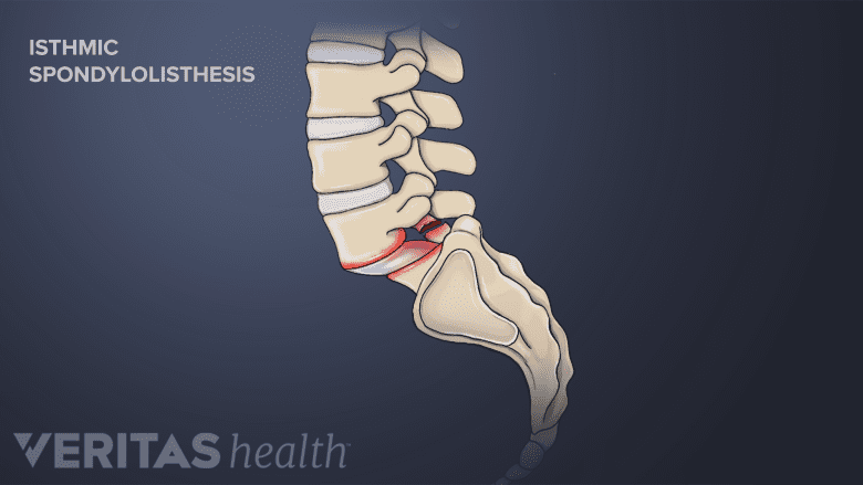 Illustration showing lower spine with isthemic spondylolisthesis.