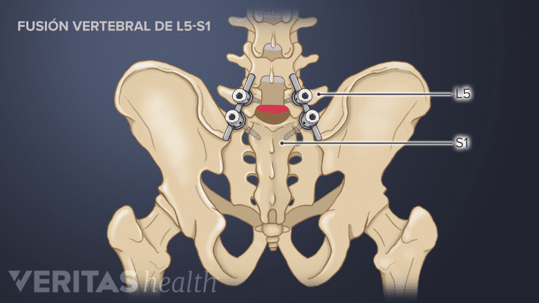 Fusión vertebral del nivel L5-S1.