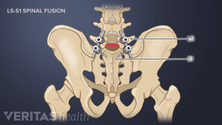 Illustration showing L5-S1 spinal fusion.