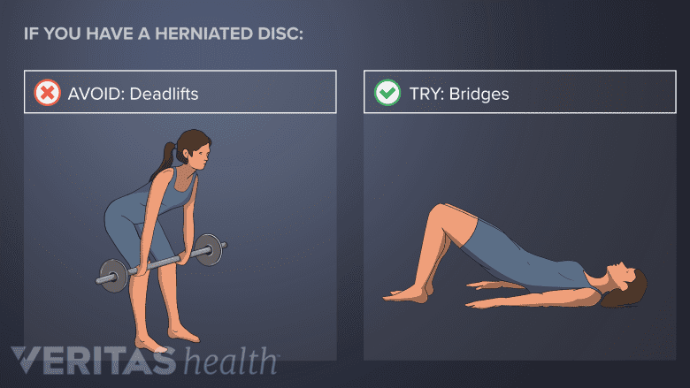 Avoid Deadlifts with lower back disc herniation. Try Bridges.
