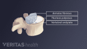 Illustration of anatomy of lumbar vertebra labelling nucleus pulpous, annulus fibrosis, and vertebral end plate.