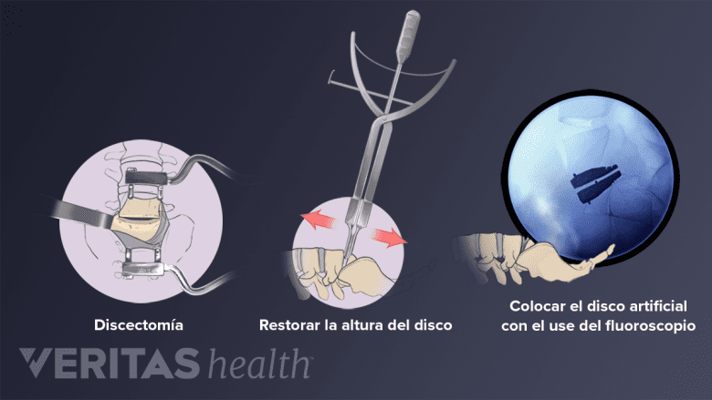El proceso del remplazo de disco artificial.