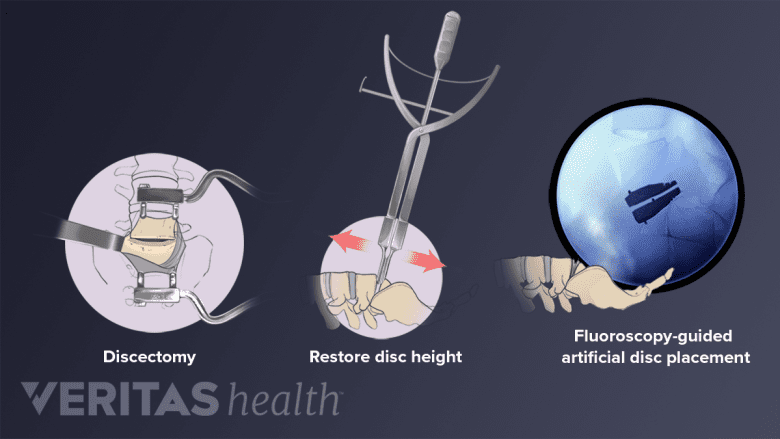 Illustration showing steps in the artificial disc replacement surgery.