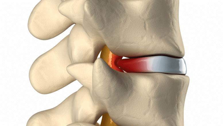 3D sagittal view of a thoracic disc herniation pressing on spinal cord.