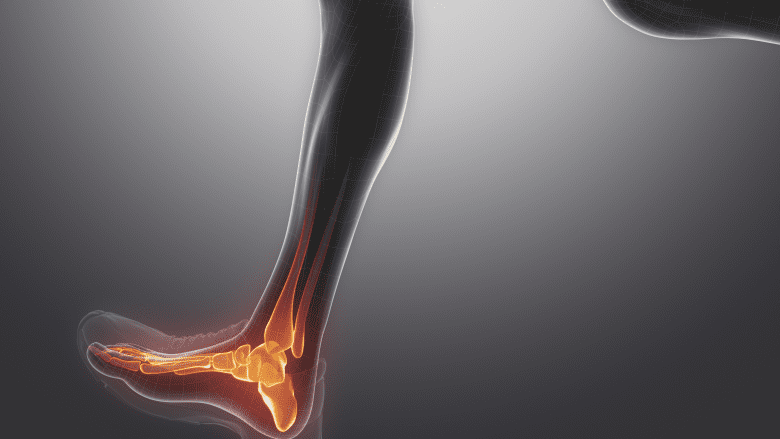 Pain in the foot from walking.
