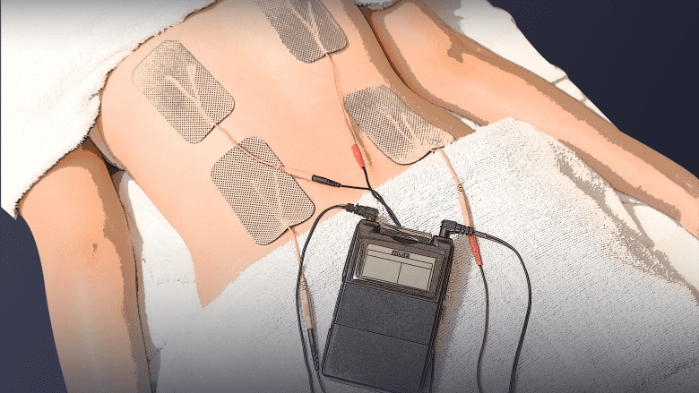 Electrodos del dispositivo TENS en el músculo de la espalda.