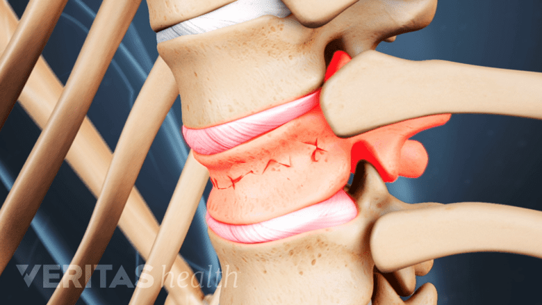 Illustration showing vertebral fracture.