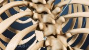 Biopsy needle being inserted during a vertebroplasty procedure