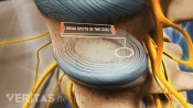 Weak spots in the disc of the lumbar spine.
