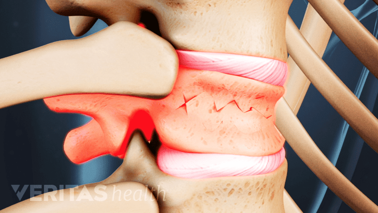 Illustration showing fractured vertebra in red.