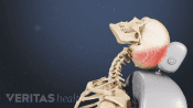 Whiplash injury to the head and neck after a car accident.