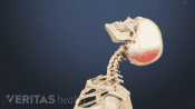 Medical illustration showing the impact of a skull on the back of a head rest in a car as the result of a car accident