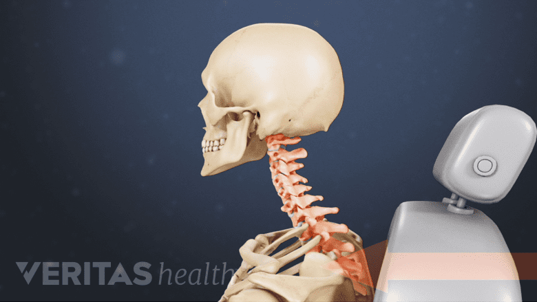 Illustration showing whiplash injury.