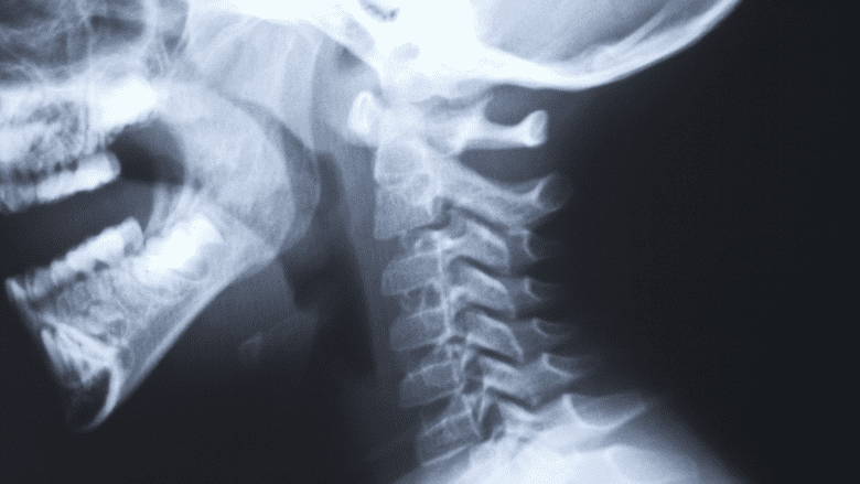 Illustration showing head and nack x-ray.
